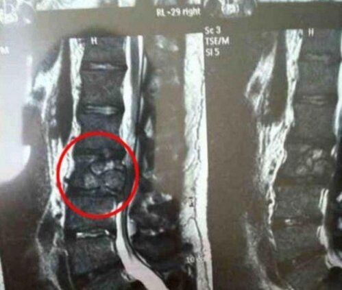 Ο όγκος της σπονδυλικής στήλης στην εικόνα