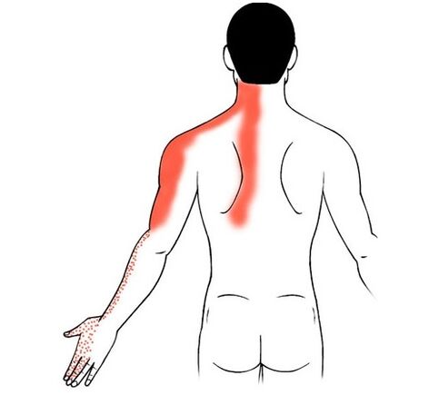 αυχενική οστεοχόνδρωση ως αιτία πόνου στις αρθρώσεις των δακτύλων